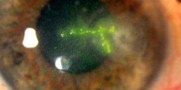 Keratoplasty following herpes simplex keratitis refractive management
